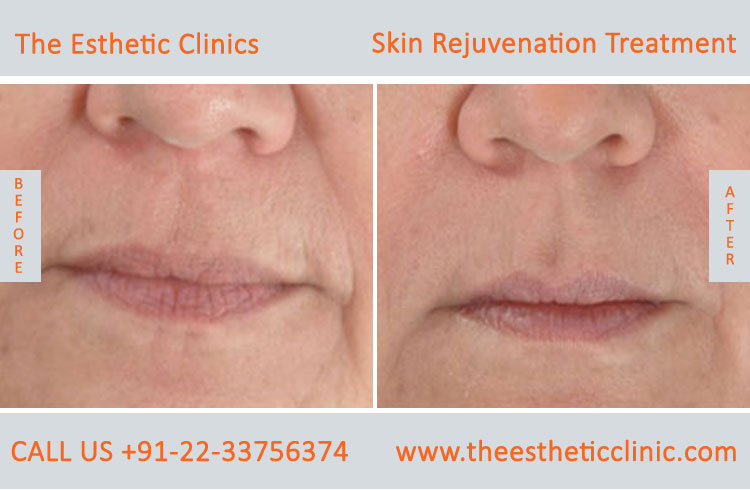 Skin Rejuvenation whitening lightening Laser Treatment before after photos in mumbai india (5)
